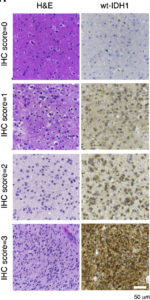 The scientists found that wildtype IDH1 was over-expressed in high-grade glioblastomas, as indicated by the immunohistochemistry brown staining on these tissue microarrays.