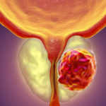 改善前列腺癌的免疫反应