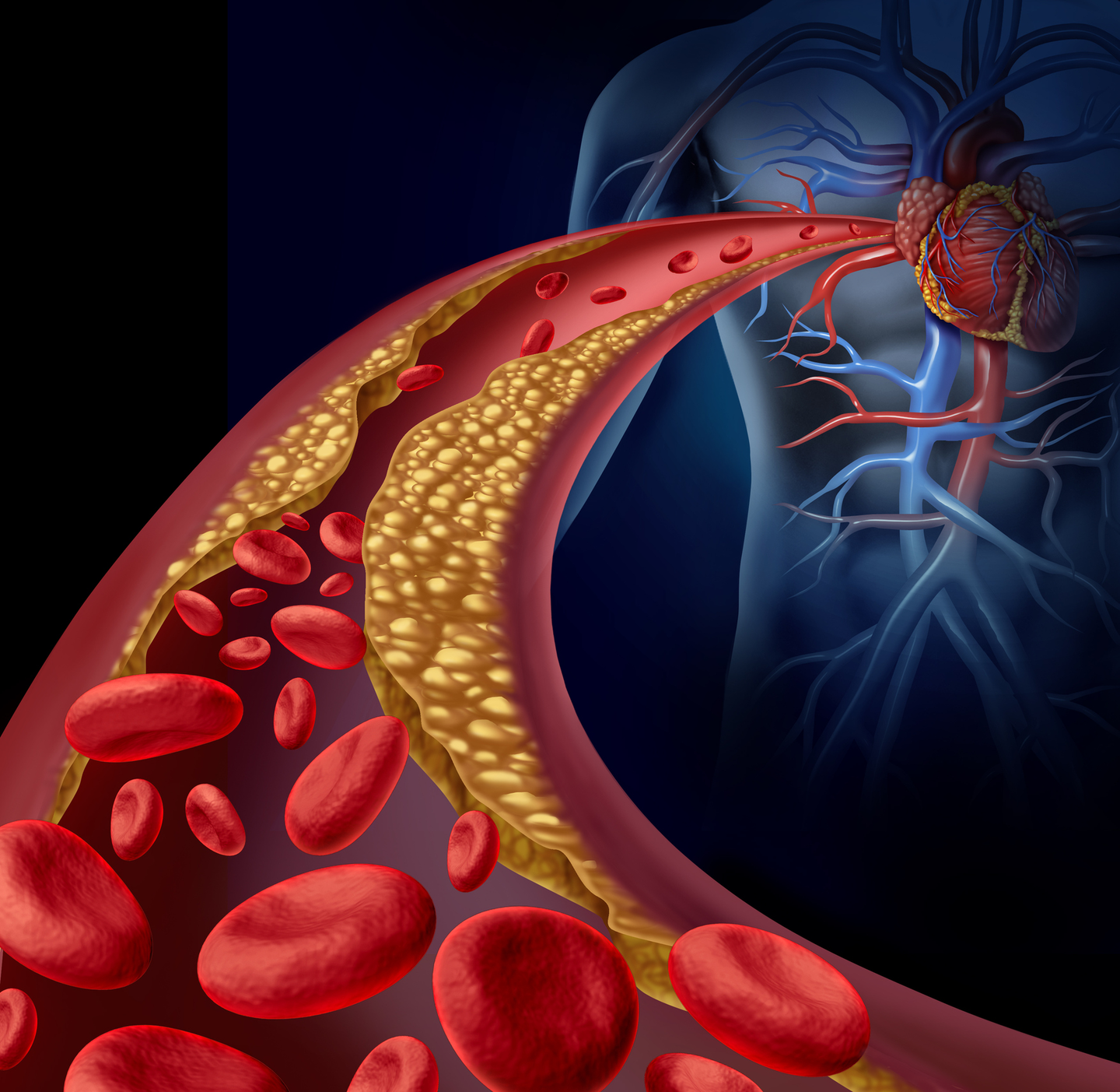 Women at Greater Risk of Stress-induced Ischemia After Heart Attacks