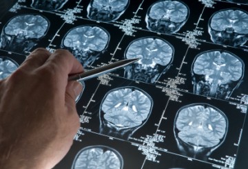 Machines see the future for patients diagnosed with brain tumors