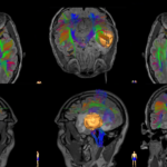 New 3D Spatial Approach Reveals Interactive View of Glioblastoma and Therapeutic Targets