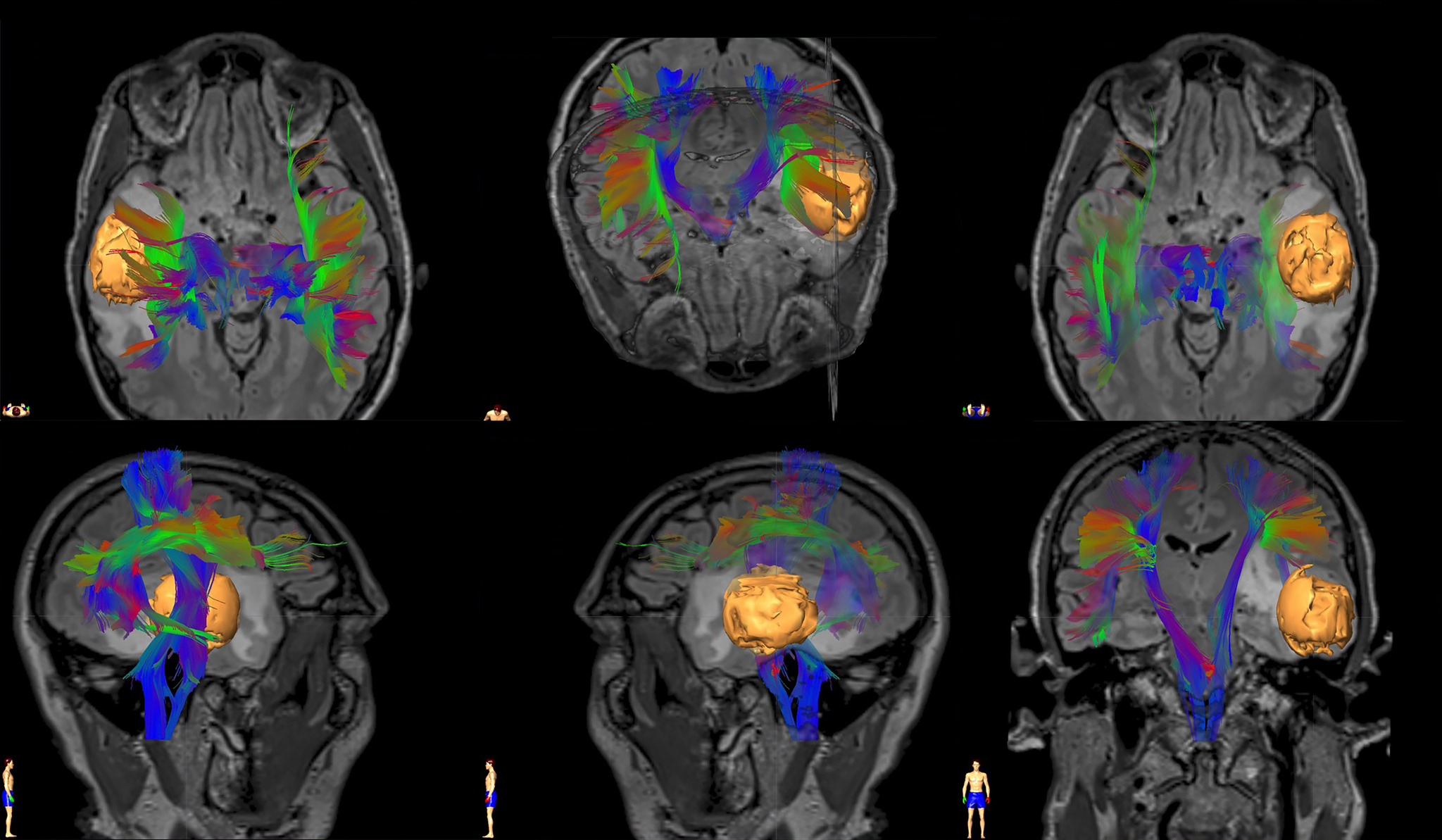 Brain Tumor SPORE Drives Rapid Translation