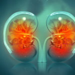 Combination Treatment May Improve Quality of Life in Kidney Cancer