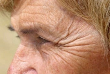 Facial exercise speeds Botox’s wrinkle reducing effects