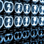 New Tumor State Helps Identify High-Risk Small-Cell Lung Cancer