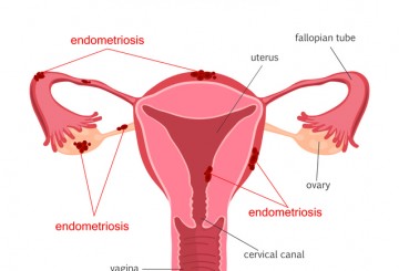 New study takes first step toward treating endometriosis