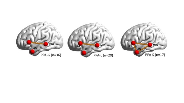 Map of Broken Brain Networks Shows Why People Lose Speech in Language-Based Dementia