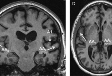 Brain region discovered that only processes spoken, not written words