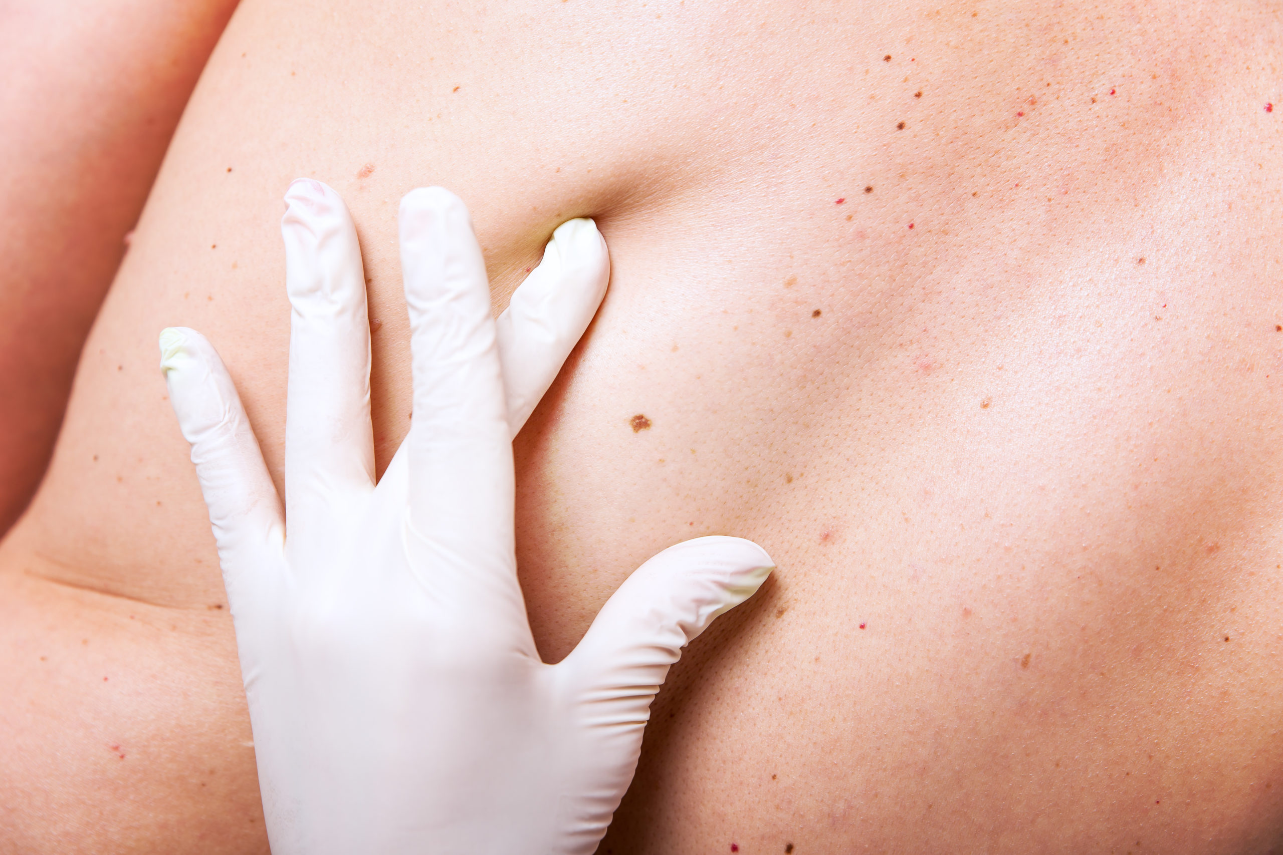 Dangerous Skin Tumor Now Has Treatment Guidelines