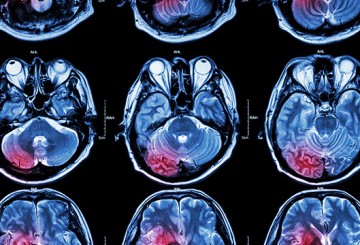 Ultrasound blasts potent glioblastoma drug into brain tumor