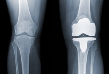 Knee replacement timing is all wrong for most