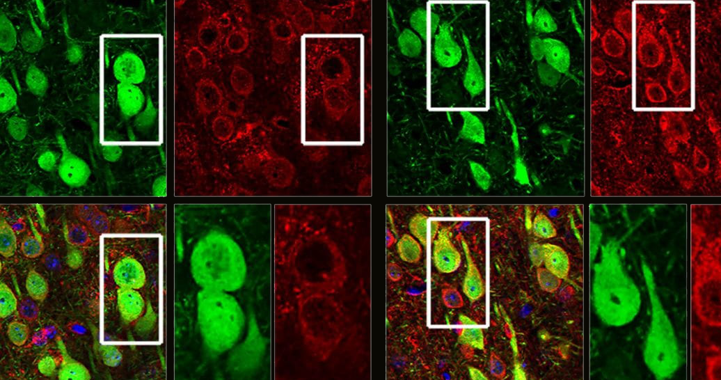 Mechanism Behind Upper Motor Neuron Degeneration Revealed