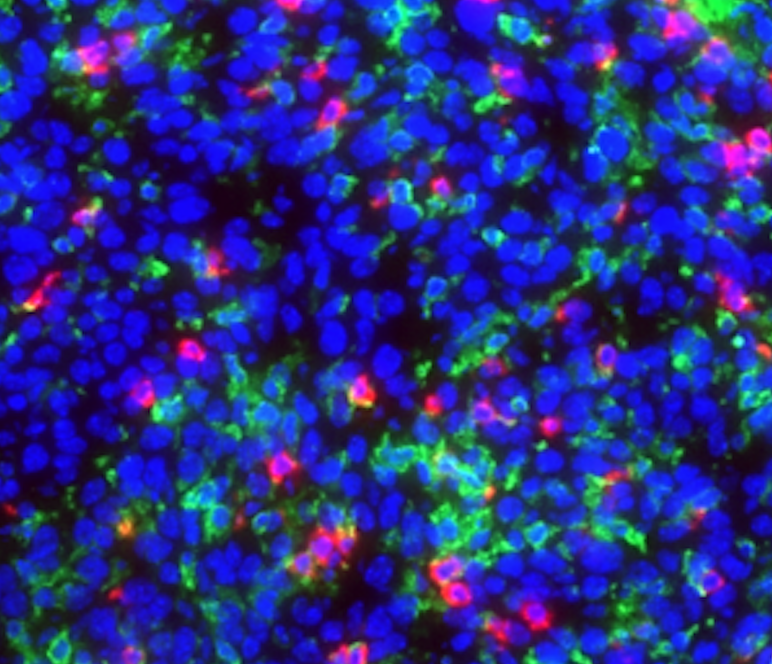 Northwestern Scientists Discover Potential Therapeutic Target for Glioblastoma