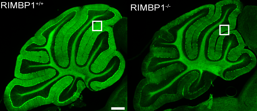 New Genetic Cause of Dystonia Revealed