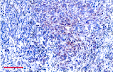 Protein Variant May Have Potential as Target for Glioblastoma