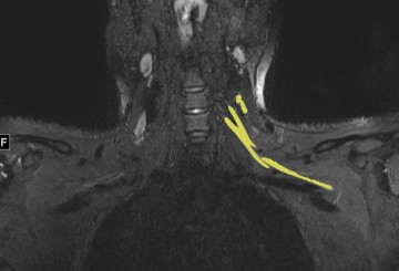 Post-COVID pain or weakness? MRI can pinpoint nerve damage