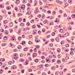 Investigating Quality of Life in Large B-cell Lymphoma