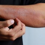 New Options for Treating Eczema
