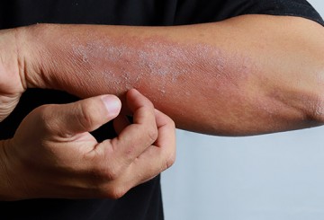 New Options for Treating Eczema