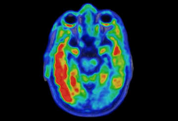 Biomarker predicts cognitive decline in Alzheimer’s disease