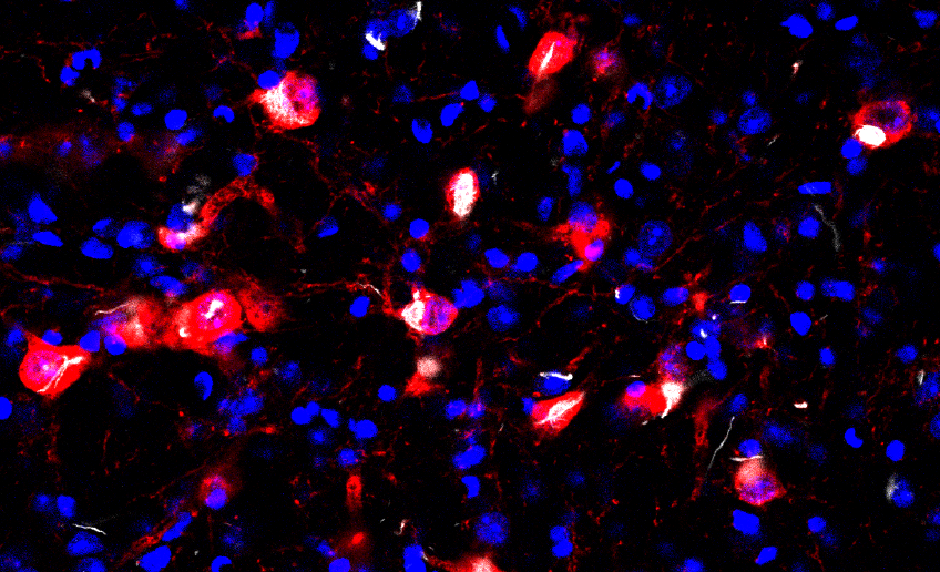 Parkinson's disease pathology