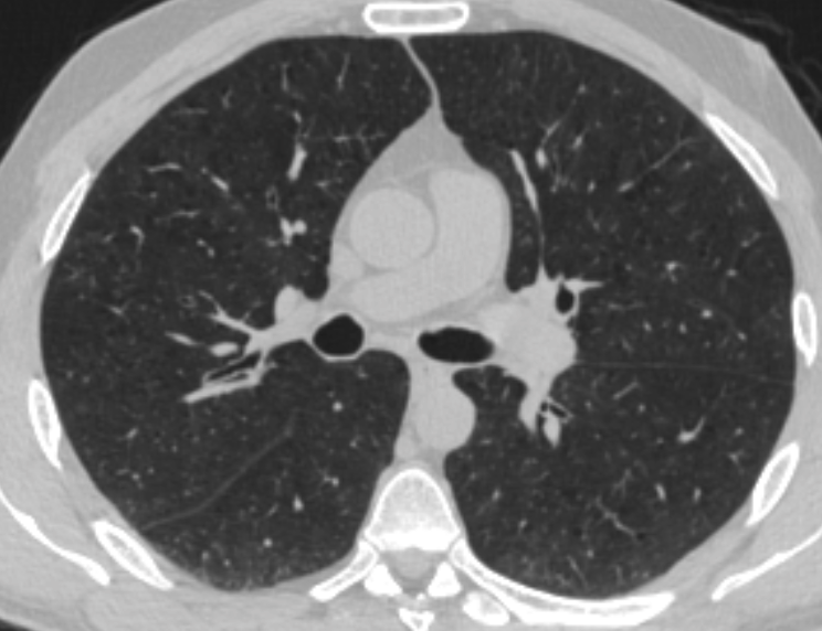 Most Common Lung Function Test Misses Lung Disease in Many Black U.S. Adults