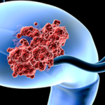 Changes to Endometrial Cancer Treatment with Daniela Matei, MD