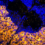 A New Way to Diagnose Glioma Brain Tumors