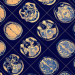 Novel Genetic Factors Contribute to Parkinson’s Risk