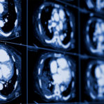 CT Scan Best at Predicting Heart Disease Risk in Middle Age