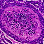 Combination Treatment Improves Survival in Endometrial Cancer
