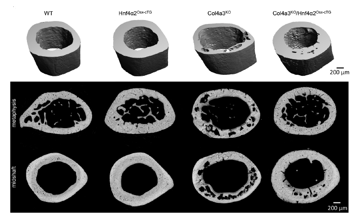 Transcription Factor Prevents Bone Frailty in Chronic Kidney Disease