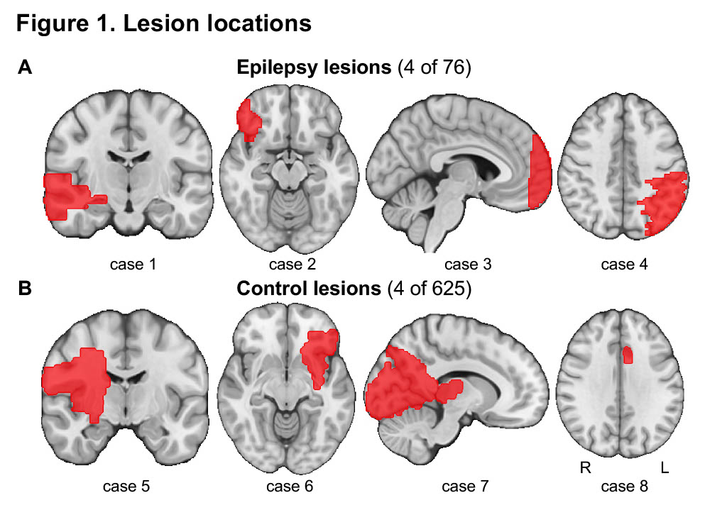 Location of Brain Lesions May Predict Seizures - News Center