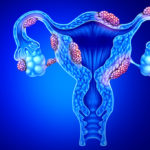 Northwestern Scientists Develop New Model for Understanding Uterine Fibroids