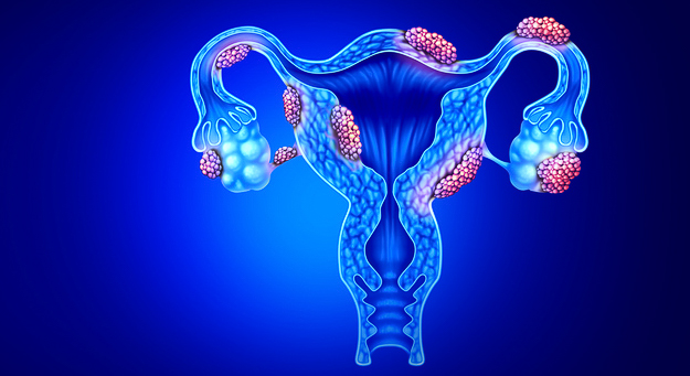 Northwestern Scientists Develop New Model for Understanding Uterine Fibroids