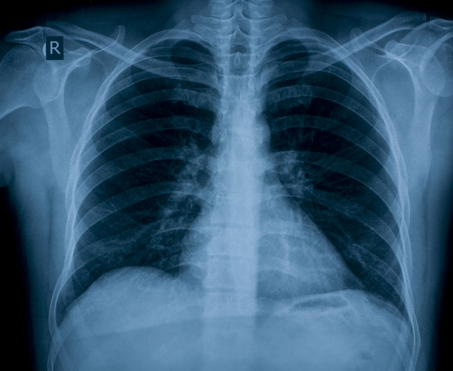 Developing Custom AI Language Models to Interpret Chest X-Rays