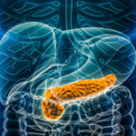 Investigating Methods for Preventing Pancreatitis after Endoscopy