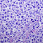 Cellular Therapy Increases Survival in Recurring B-cell Lymphoma 