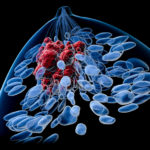 Combination Therapy Shows Promise in Subset of Breast Cancers