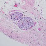 Antioxidant Gel Preserves Islet Function After Pancreas Removal