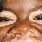 Microbial Therapy Offers New Hope for Vitiligo Patients