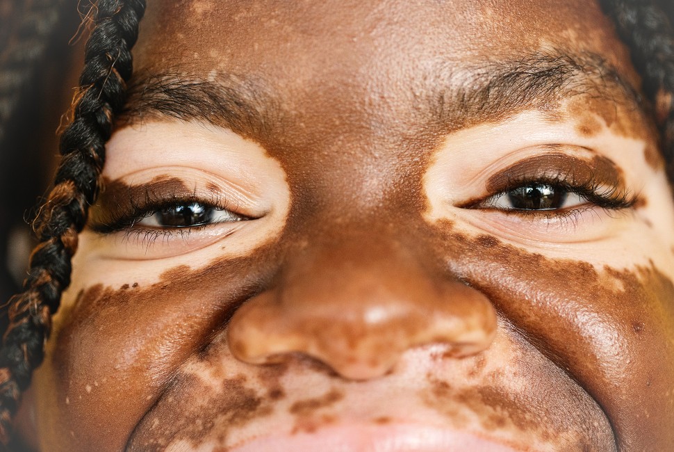 Microbial Therapy Offers New Hope for Vitiligo Patients