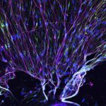 Understanding How Neurofilaments Clog Up Brain Functions