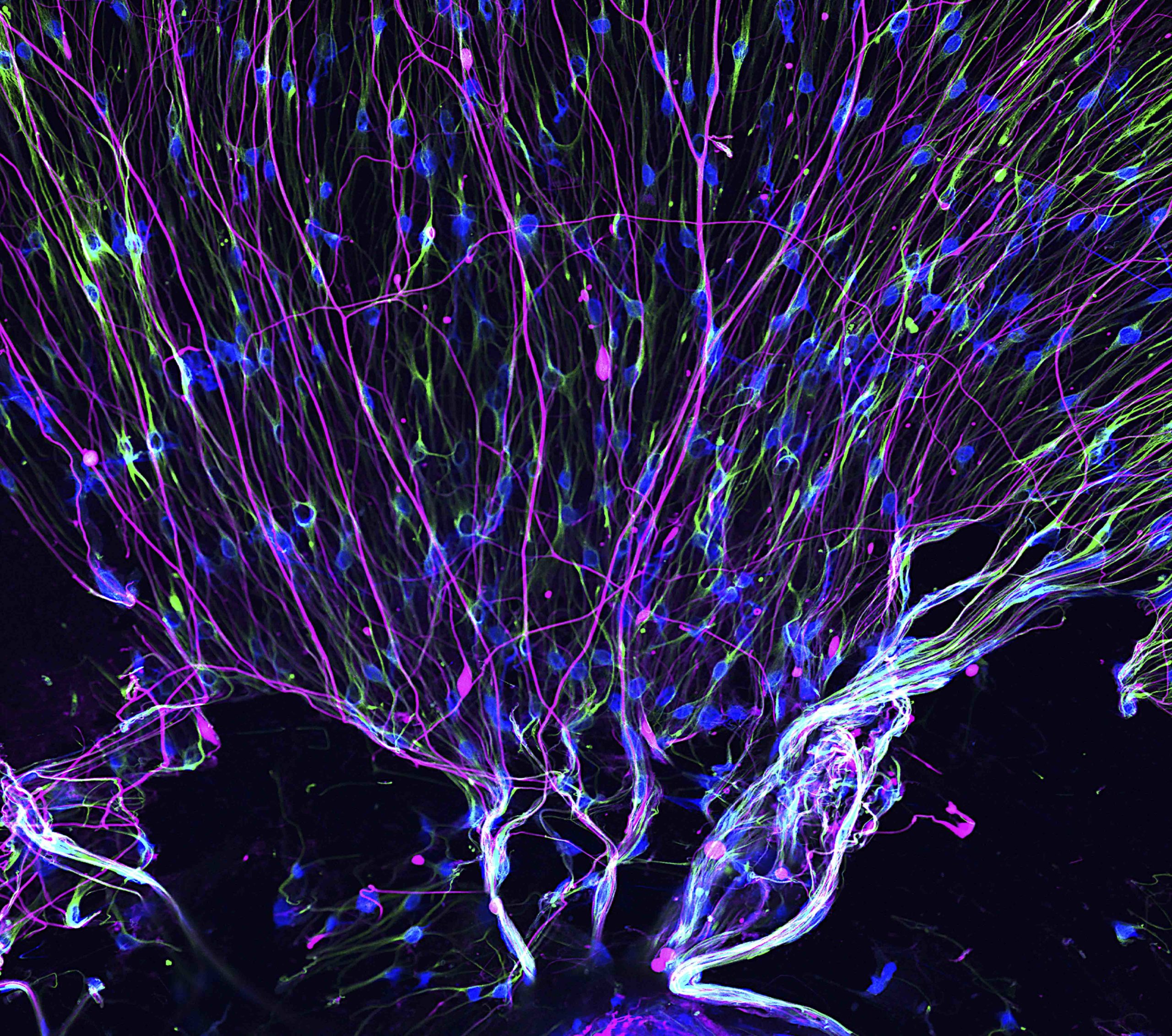 Understanding How Neurofilaments Clog Up Brain Functions