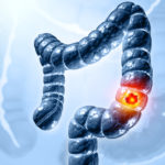 New Scoring System Improves Colorectal Cancer Risk Prediction