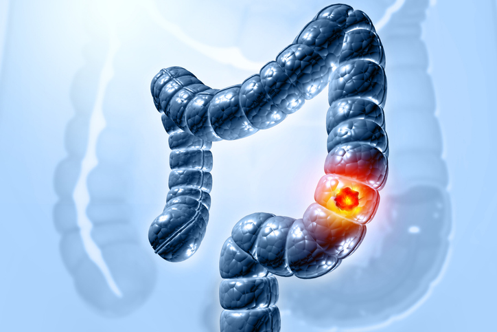 New Scoring System Improves Colorectal Cancer Risk Prediction