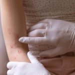 Measuring the Severity of Debilitating Skin Disorders 