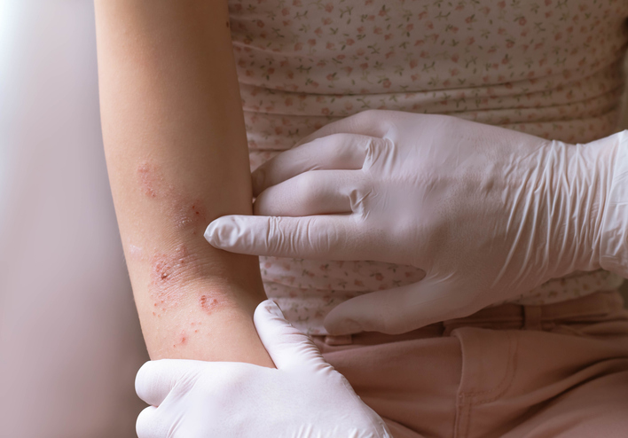 Measuring the Severity of Debilitating Skin Disorders
