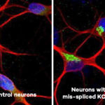 A New Clue to ALS and FTD: Faulty Protein Disrupts Brain’s ‘Brake’ System