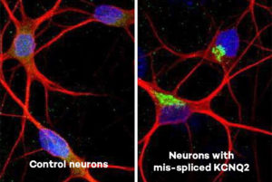 Side-by-side image shows control neurons from a recently published study (left) compared to neurons from the study with the mis-spliced KCNQ2 gene.